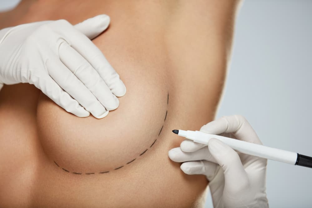 Doctor drawing surgery lines below breast