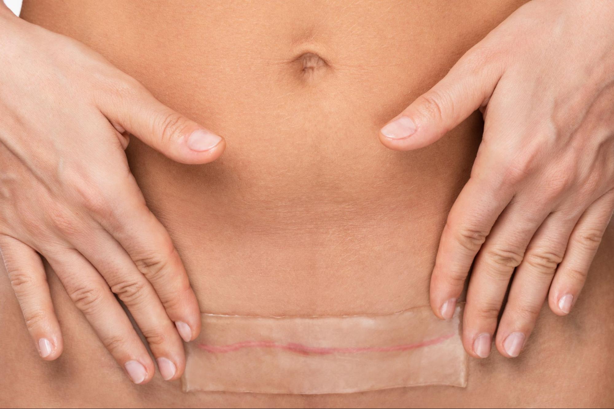 Woman's abdomen scar