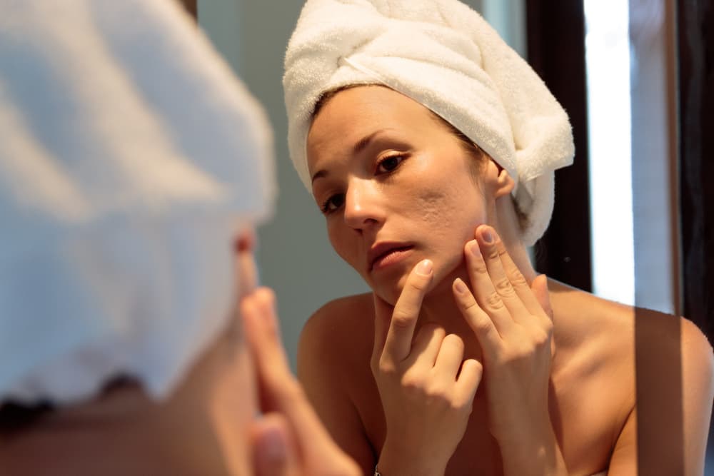 Woman examining acne scars in mirror