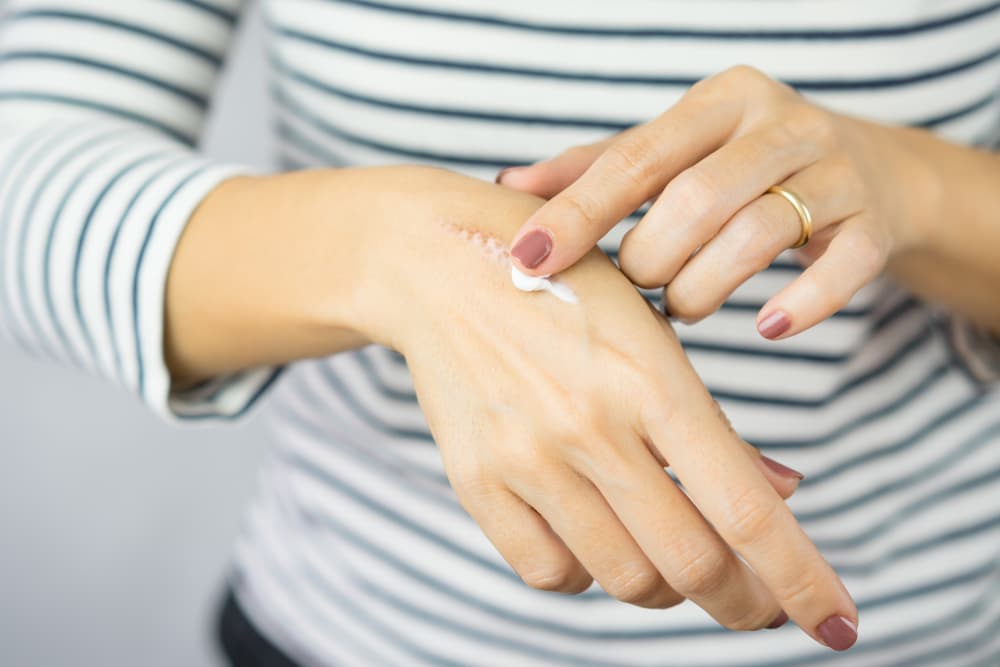 Woman applying scar cream to wrist