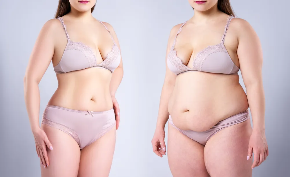 Before and after photos of a tummy tuck