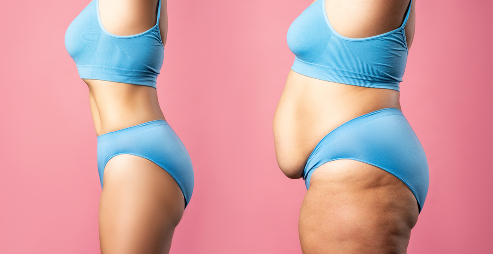 High Bmi / Plus Size Awake Liposuction: An Exciting Option