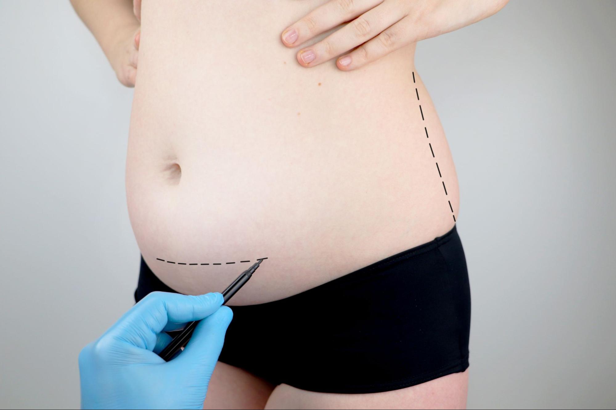 Woman with pre-surgery markings