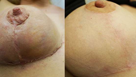 Breast Procedure