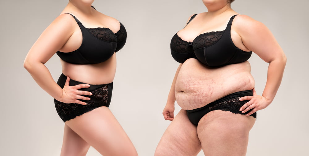 Woman showing off results of tummy tuck, in comparison to before photo