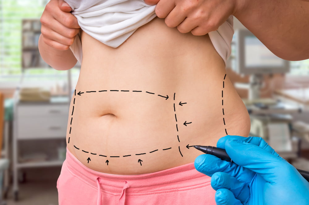 Plastic surgeon marking up woman’s stomach to prepare for tummy tuck operation