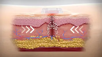 Crossection of tissue showing the shrink process - step 1.