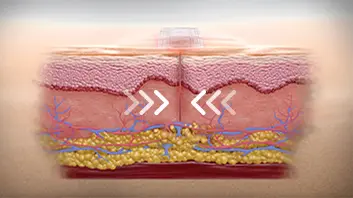 Crossection of tissue showing the shrink process - step 2