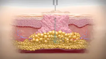 Crossection of tissue indicating the trauma.